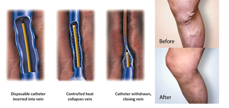 VNUS Closure