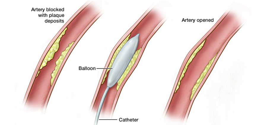 icd 10 code for peripheral angioplasty