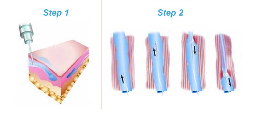 Sclerotherapy
